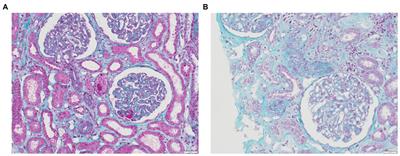 Pregnancy as a susceptible state for thrombotic microangiopathies